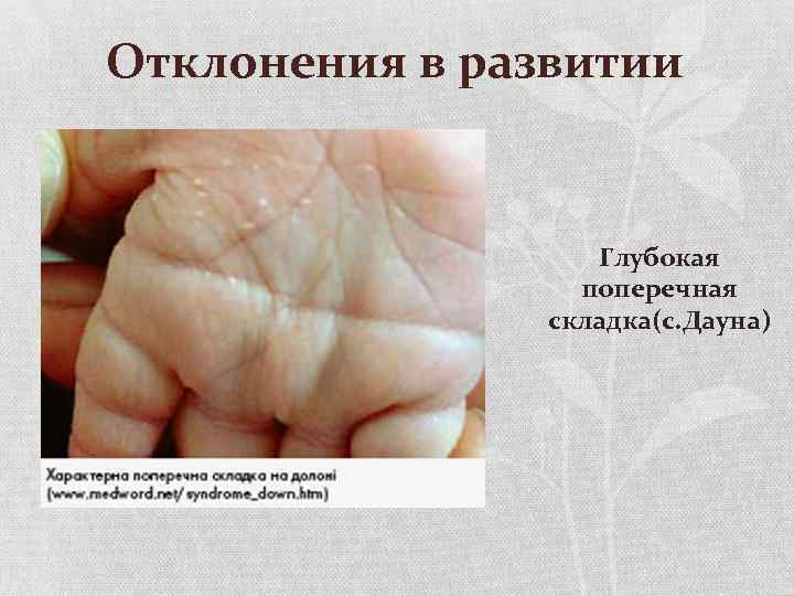 Отклонения в развитии Глубокая поперечная складка(с. Дауна) 