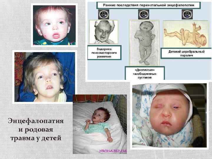 Энцефалопатия и родовая травма у детей 