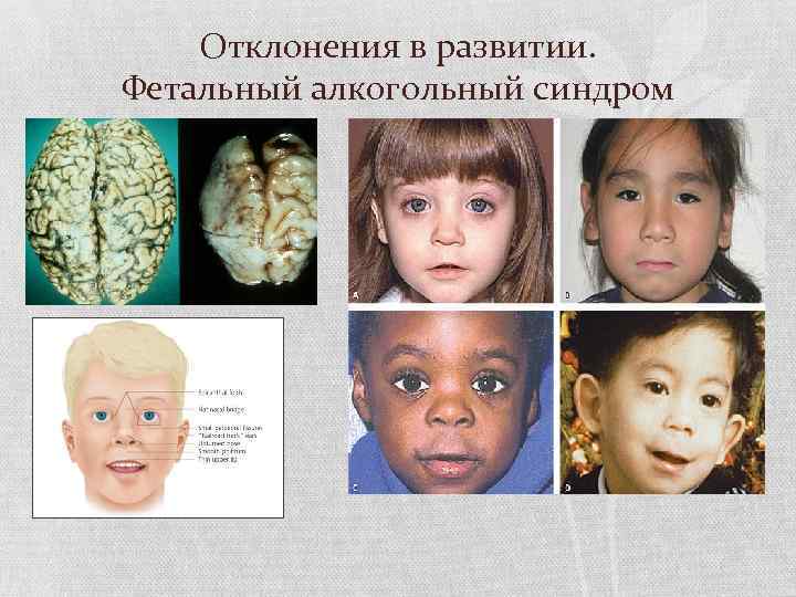 Отклонения в развитии. Фетальный алкогольный синдром 