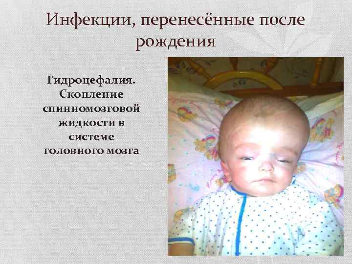 Инфекции, перенесённые после рождения Гидроцефалия. Скопление спинномозговой жидкости в системе головного мозга 