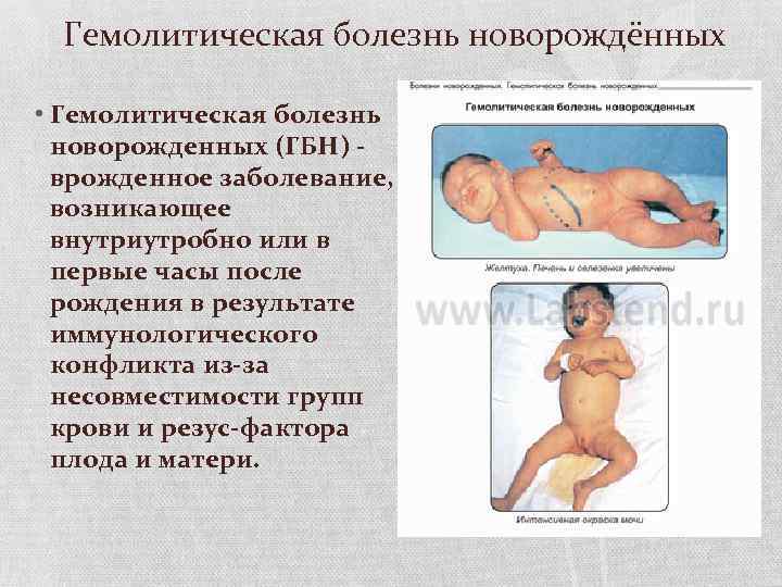 Гемолитическая болезнь новорождённых • Гемолитическая болезнь новорожденных (ГБН) врожденное заболевание, возникающее внутриутробно или в