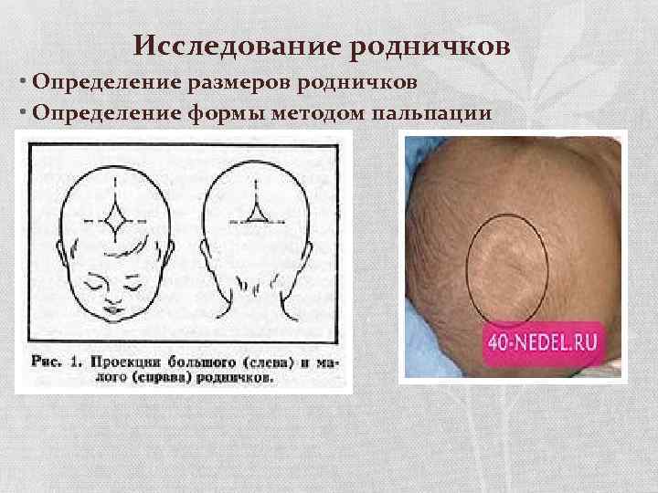 Исследование родничков • Определение размеров родничков • Определение формы методом пальпации 