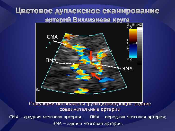 Мра картина варианта развития виллизиева круга в виде полной задней трифуркации левой вса