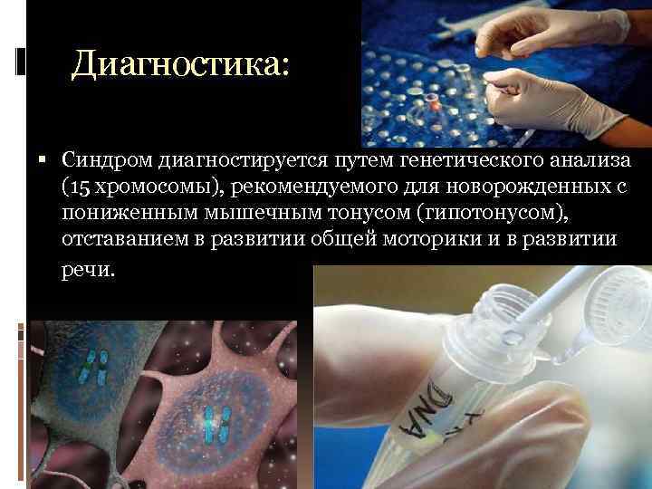 Диагностика: Синдром диагностируется путем генетического анализа (15 хромосомы), рекомендуемого для новорожденных с пониженным мышечным