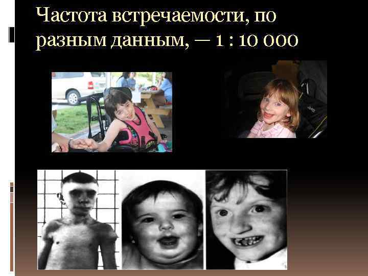 Частота встречаемости, по разным данным, — 1 : 10 000 