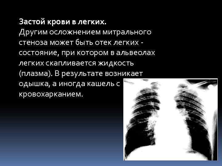 Застой крови в легких. Другим осложнением митрального стеноза может быть отек легких состояние, при