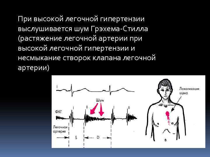 Аускультативная картина легочной гипертензии