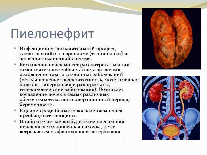 Пиелонефрит Инфекционно-воспалительный процесс, развивающийся в паренхиме (ткани почки) и чашечно-лоханочной системе. Воспаление почек может