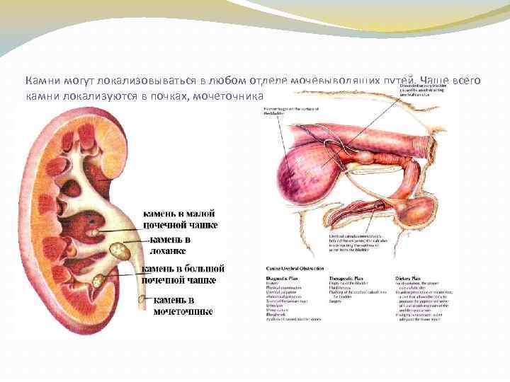 Камни могут локализовываться в любом отделе мочевыводящих путей. Чаще всего камни локализуются в почках,