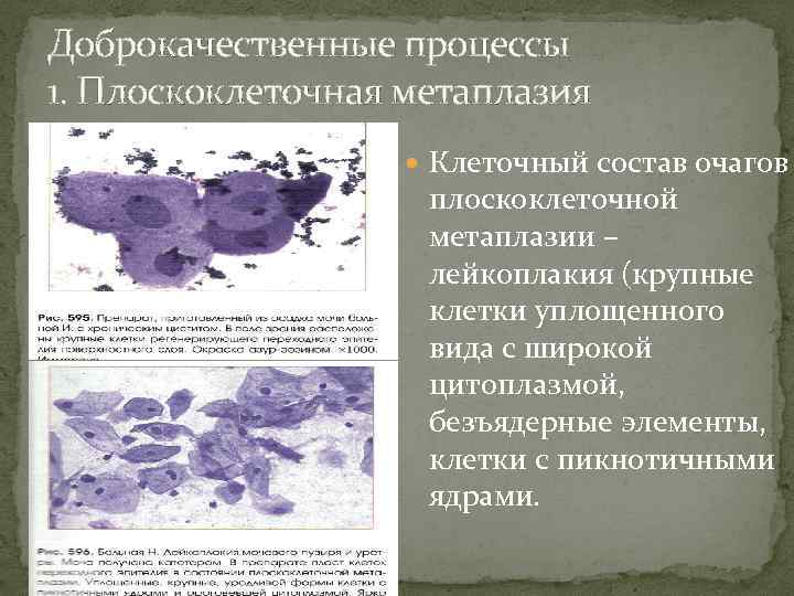 Реактивная атипия эпителия. Плоскоклеточная метаплазия клинические рекомендации. Плоскоклеточная метаплазия цитология.