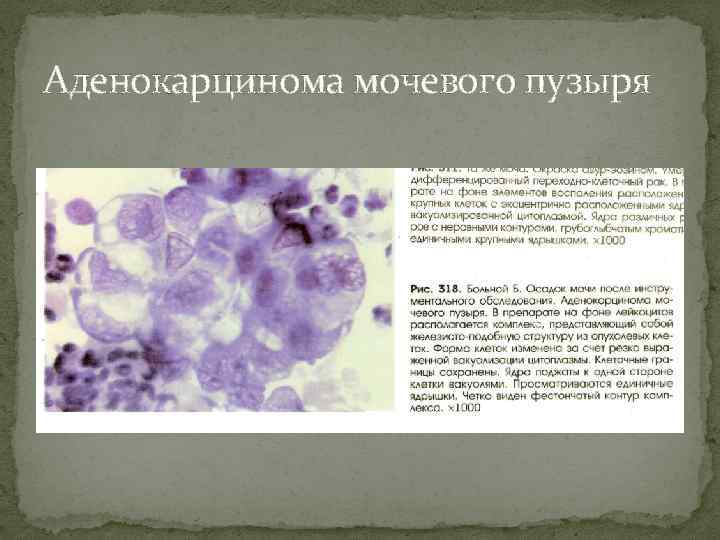 Атипичные клетки в цитологии что это. Аденокарцинома мочевого пузыря гистология. Цитология опухоли мочевого пузыря. Аденокарцинома предстательной железы гистология. Карцинома мочевого пузыря цитология.