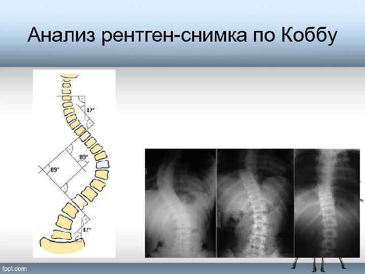 Анализ рентген-снимка по Коббу 