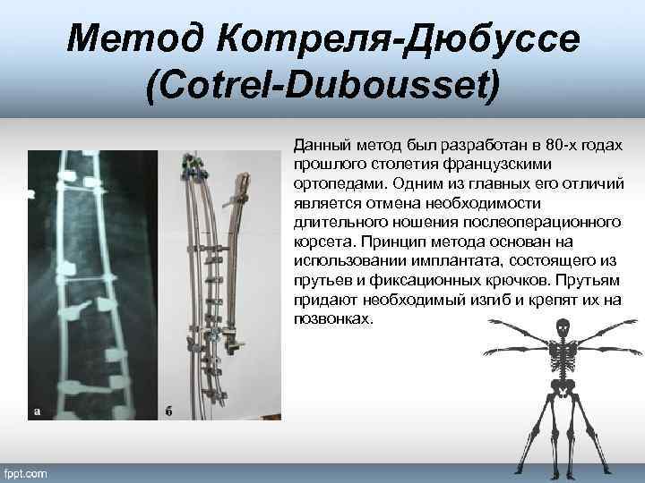 Сколиотическая болезнь травматология презентация