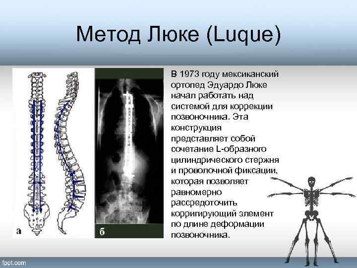 Метод Люке (Luque) В 1973 году мексиканский ортопед Эдуардо Люке начал работать над системой