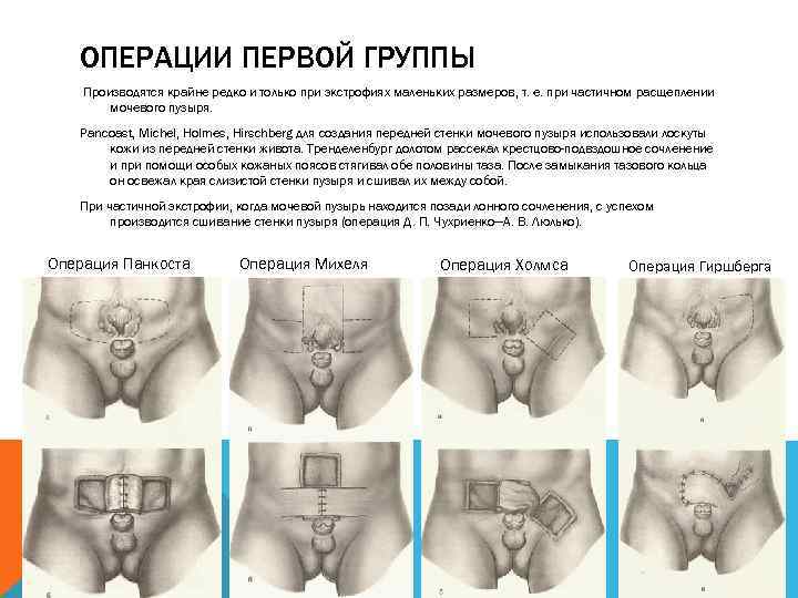 ОПЕРАЦИИ ПЕРВОЙ ГРУППЫ Производятся крайне редко и только при экстрофиях маленьких размеров, т. е.