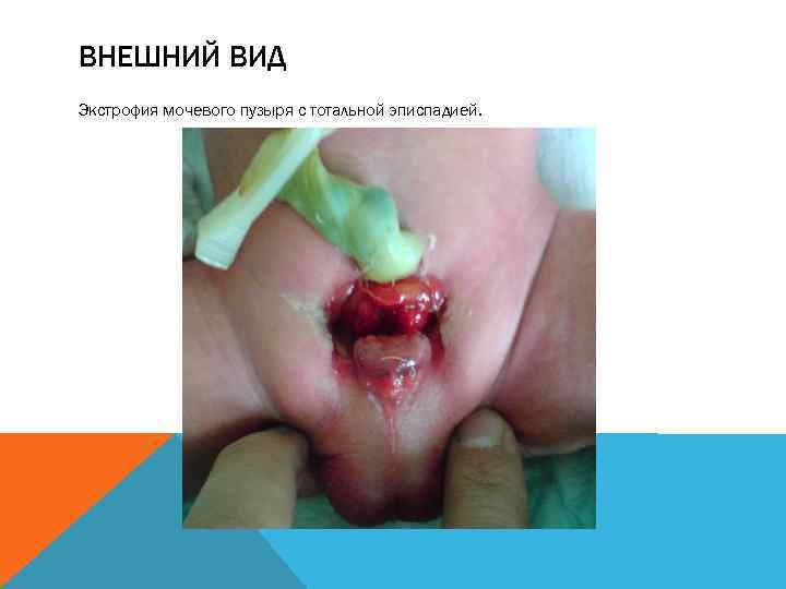 ВНЕШНИЙ ВИД Экстрофия мочевого пузыря с тотальной эписпадией. 