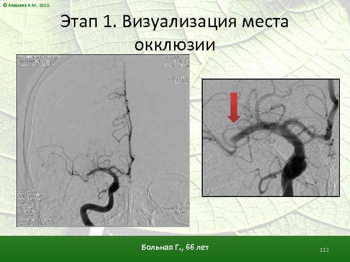 © Алашеев А. М. , 2015 Этап 1. Визуализация места окклюзии Больная Г. ,