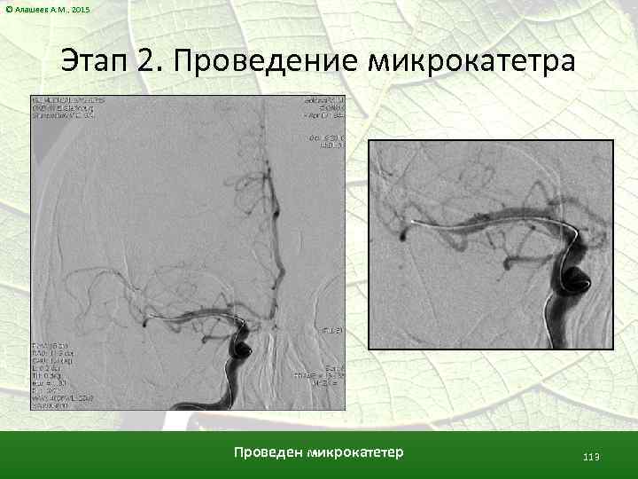 © Алашеев А. М. , 2015 Этап 2. Проведение микрокатетра Проведен микрокатетер 113 