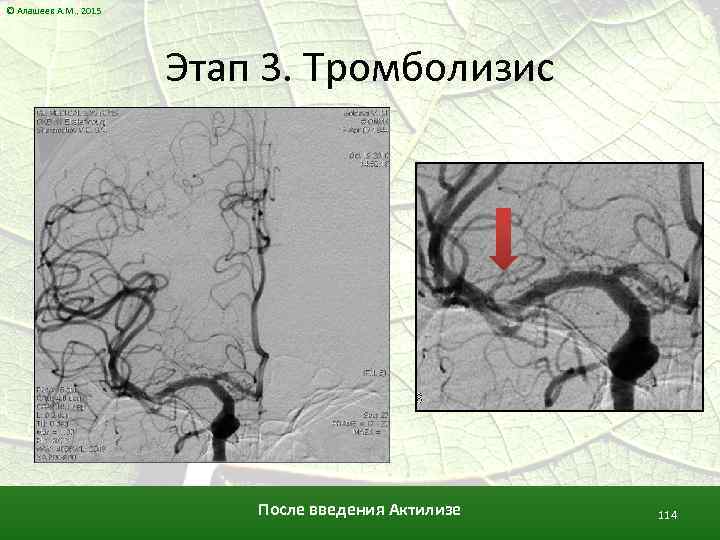 © Алашеев А. М. , 2015 Этап 3. Тромболизис После введения Актилизе 114 