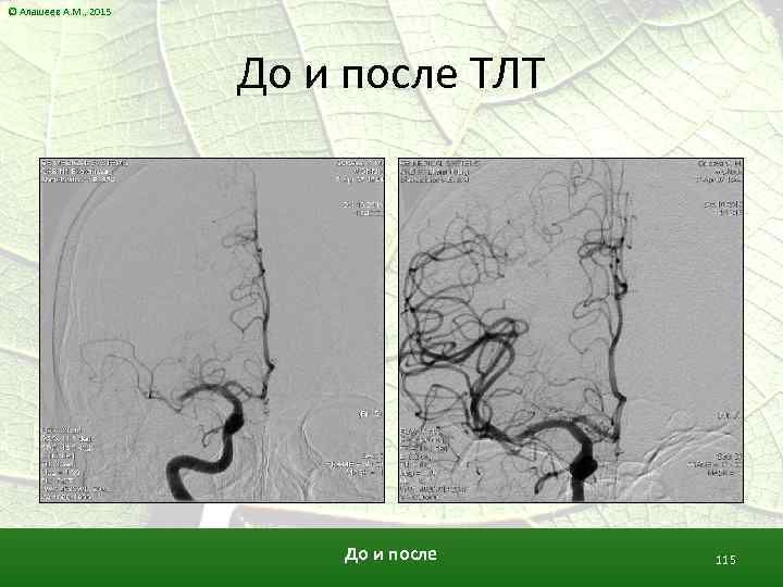 © Алашеев А. М. , 2015 До и после ТЛТ До и после 115