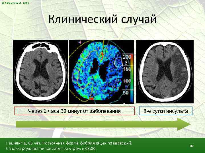 © Алашеев А. М. , 2015 Клинический случай Через 2 часа 30 минут от