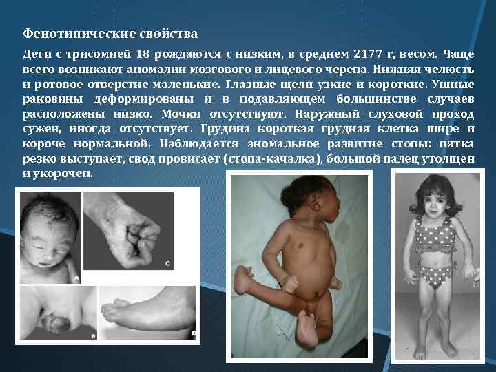 Фенотипические свойства Дети с трисомией 18 рождаются с низким, в среднем 2177 г, весом.