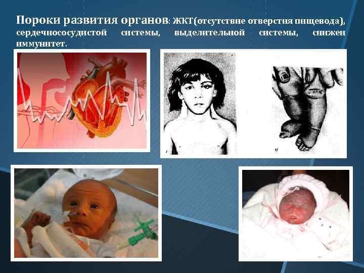 Пороки развития органов: ЖКТ(отсутствие отверстия пищевода), сердечнососудистой иммунитет. системы, выделительной системы, снижен 
