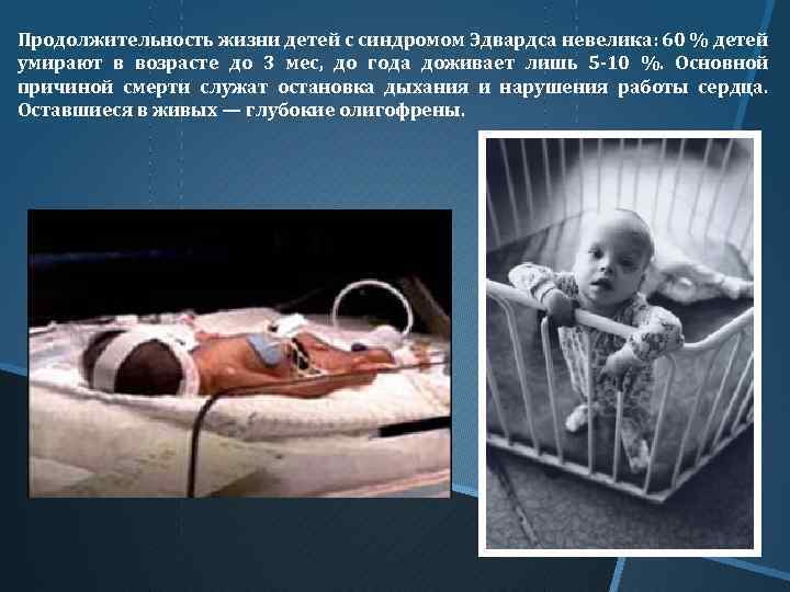 Продолжительность жизни детей с синдромом Эдвардса невелика: 60 % детей умирают в возрасте до
