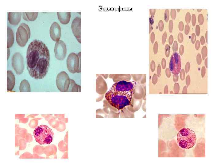 Ядро эозинофила. Эозинофилы микроскопия. Эозинофилы в микроскоп. Эозинофилпод микроскопом. Эозинофилы под микроскопом в крови.