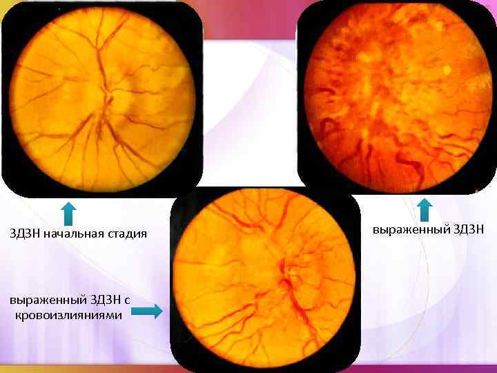 ЗДЗН начальная стадия выраженный ЗДЗН с кровоизлияниями выраженный ЗДЗН 