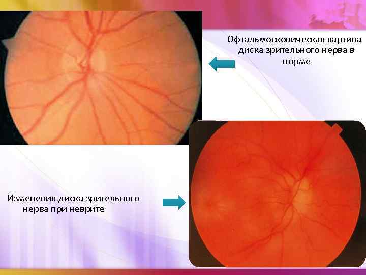 Офтальмоскопическая картина диска зрительного нерва в норме Изменения диска зрительного нерва при неврите 