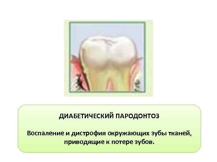 ДИАБЕТИЧЕСКИЙ ПАРОДОНТОЗ Воспаление и дистрофия окружающих зубы тканей, приводящие к потере зубов. 