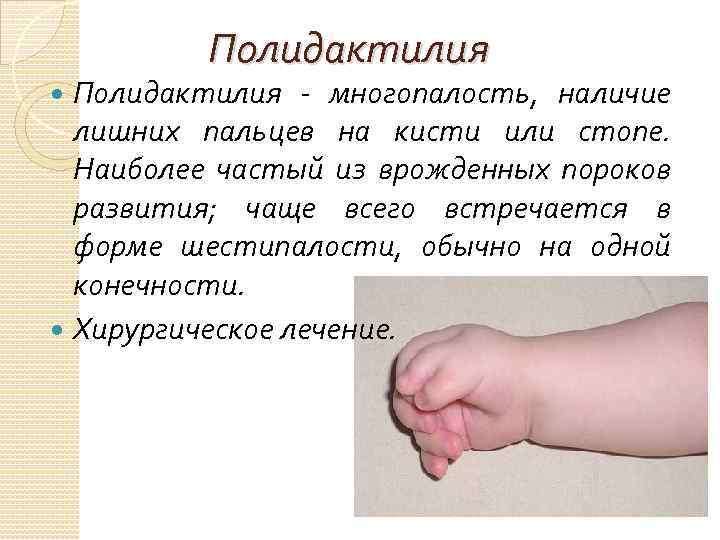 Полидактилия - многопалость, наличие лишних пальцев на кисти или стопе. Наиболее частый из врожденных