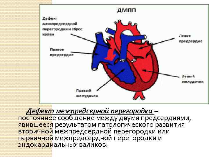  Дефект межпредсерной перегородки – постоянное сообщение между двумя предсердиями, явившееся результатом патологического развития