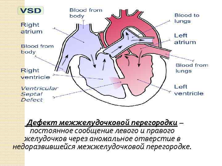  Дефект межжелудочковой перегородки – постоянное сообщение левого и правого желудочков через аномальное отверстие