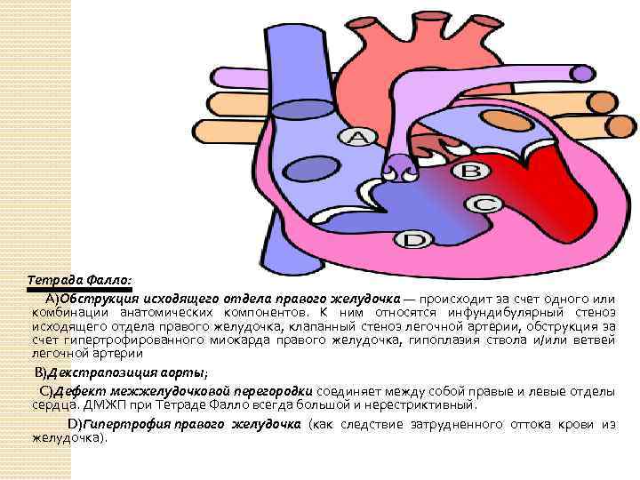 Тетрада Фалло: A)Обструкция исходящего отдела правого желудочка — происходит за счет одного или комбинации