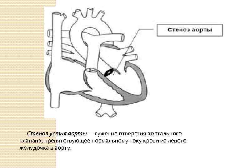  Стеноз устья аорты — сужение отверстия аортального клапана, препятствующее нормальному току крови из