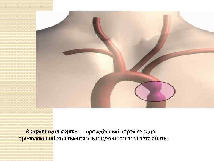 Коарктация аорты — врождённый порок сердца, проявляющийся сегментарным сужением просвета аорты. 