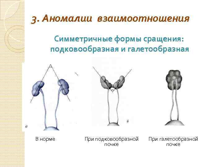 3. Аномалии взаимоотношения Симметричные формы сращения: подковообразная и галетообразная В норме При подковообразной При