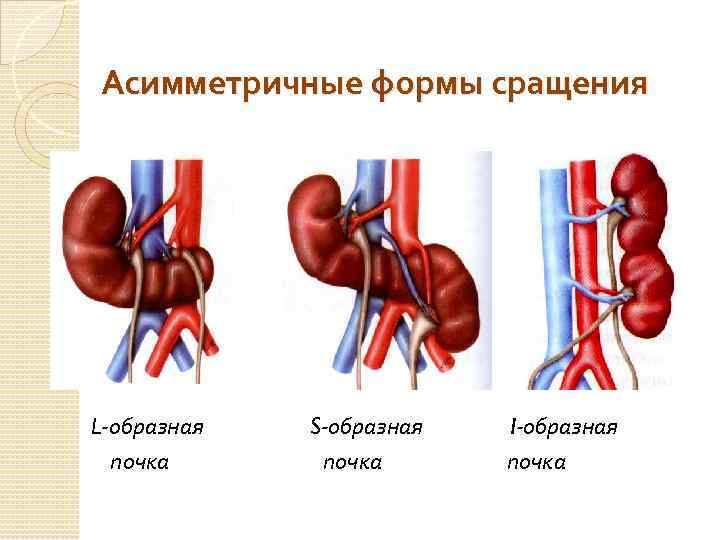 Асимметричные формы сращения L-образная S-образная I-образная почка 