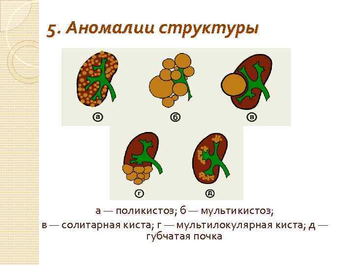 5. Аномалии структуры а — поликистоз; б — мультикистоз; в — солитарная киста; г