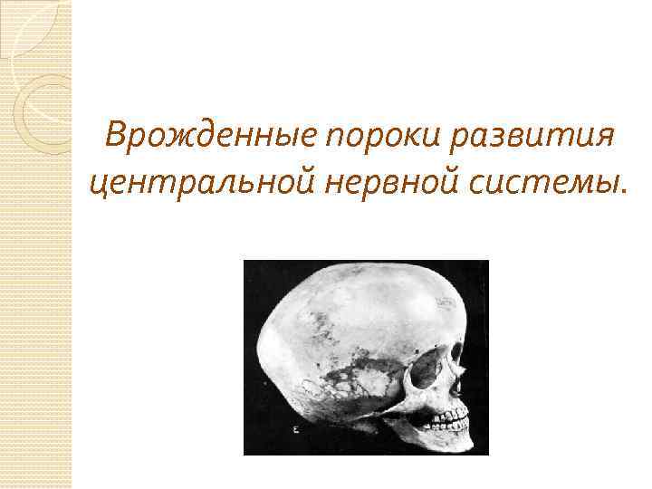 Врожденные пороки развития центральной нервной системы. 