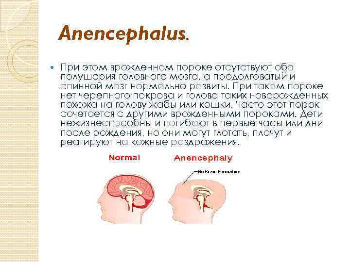 Anencephalus. При этом врожденном пороке отсутствуют оба полушария головного мозга, а продолговатый и спинной