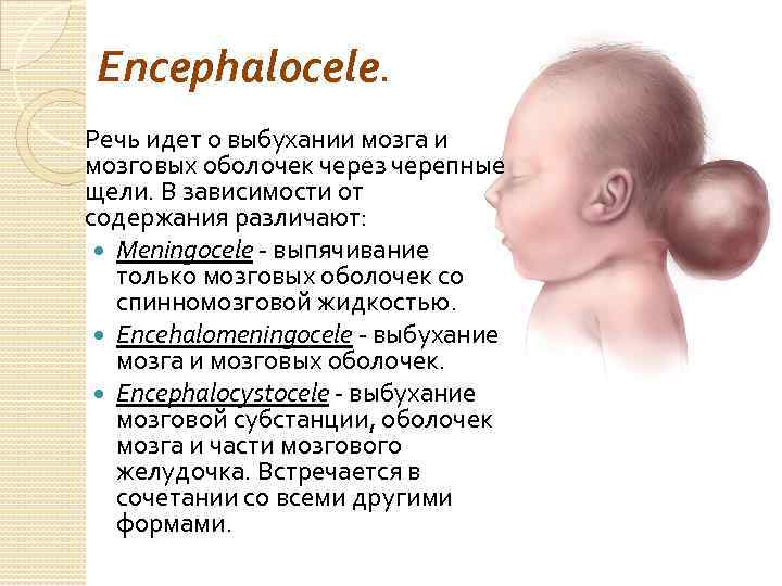 Encephalocele. Речь идет о выбухании мозга и мозговых оболочек через черепные щели. В зависимости