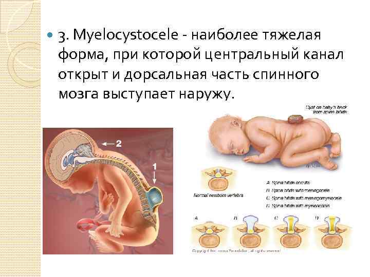  3. Myelocystocele - наиболее тяжелая форма, при которой центральный канал открыт и дорсальная