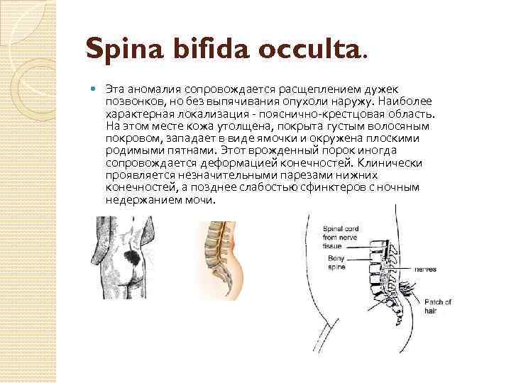 Spina bifida occulta. Эта аномалия сопровождается расщеплением дужек позвонков, но без выпячивания опухоли наружу.