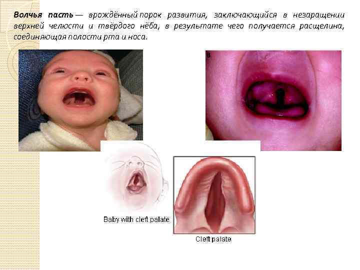 Волчья пасть — врождённый порок развития, заключающийся в незаращении верхней челюсти и твёрдого нёба,