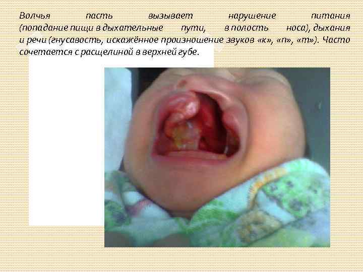 Волчья пасть вызывает нарушение питания (попадание пищи в дыхательные пути, в полость носа), дыхания