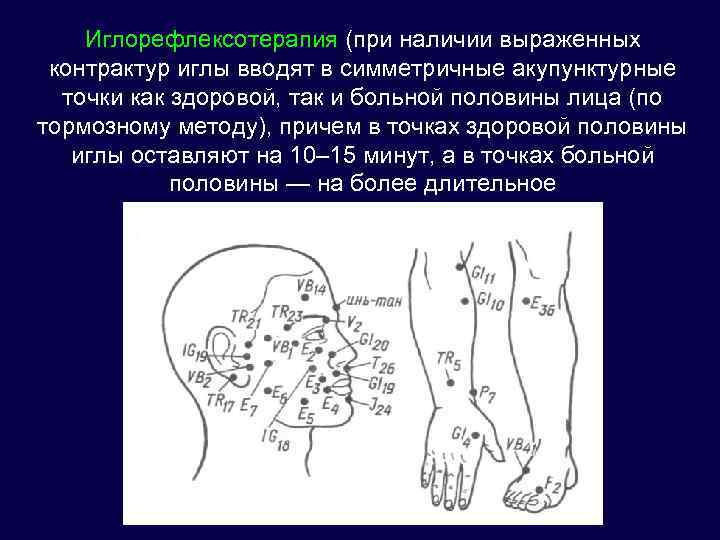 Иглорефлексотерапия (при наличии выраженных контрактур иглы вводят в симметричные акупунктурные точки как здоровой, так