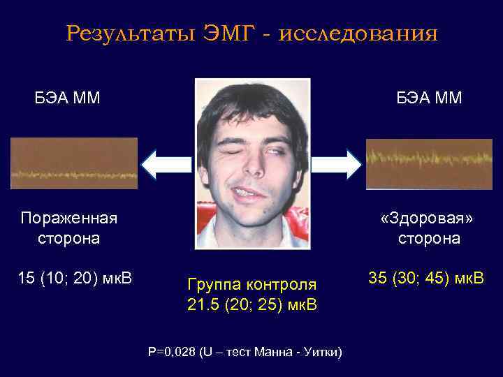 Результаты ЭМГ - исследования БЭА ММ Пораженная сторона «Здоровая» сторона 15 (10; 20) мк.